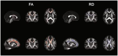 Sensation seeking correlates with increased white matter integrity of structures associated with visuospatial processing in healthy adults